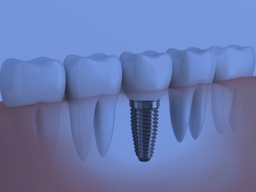 Implante Dentário